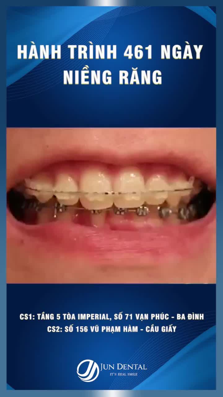 Có ai thắc mắc răng mình sẽ di chuyển như thế nào trong suốt quá trình niềng răng không ạ?