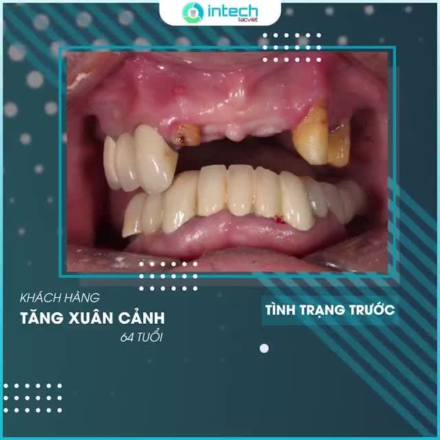 HÀM RĂNG CHẮC KHỎE SAU KHI TRỒNG RĂNG IMPLANT TOÀN HÀM TRÊN