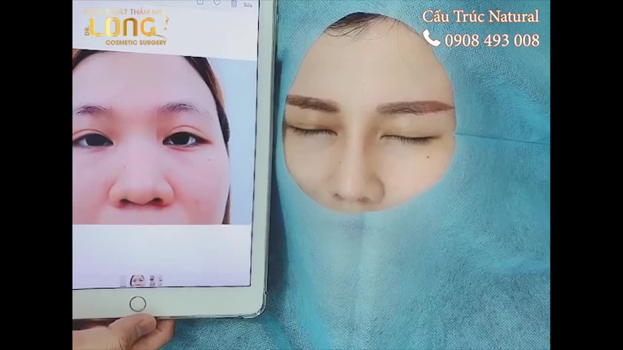 Mũi thấp thành cao chỉ sau 45 phút tin được không