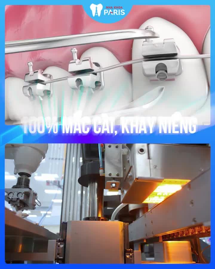 Răng Hô - Thưa - Móm - Khấp khểnh. Phải làm sao?