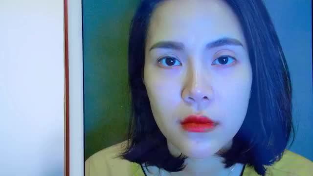 Bác sĩ làm việc xuyên trưa GIẢI CỨU THÀNH CÔNG xuất sắc ca MÍ LỖI HỎNG do thẩm mỹ mắt tại cơ sở không uy tín bằng kỹ thuật sửa mí DeepTech20 tại Dr.Hải Lê