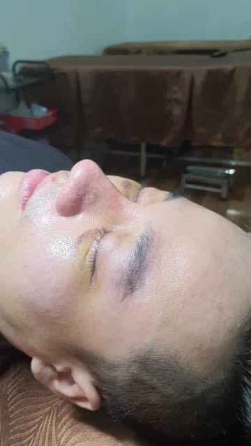 TÁI KHÁM MŨI SAU 11 NGÀY MŨI ĐẸP CHO NAM GIỚI