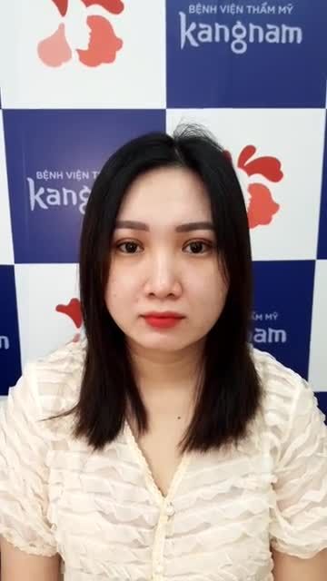 Xinh đẹp như búp bê với Cắt mí Plasma