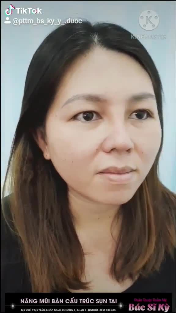 NÂNG MŨI THAY ĐỔI PHONG THỦY MANG ĐẾN DIỆN MẠO HOÀN TOÀN MỚI