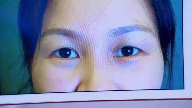 Vẫn là lời khuyên đó: "Nếu mắt sụp mí già nua, u buồn, che khuất tầm nhìn ảnh hưởng thị lực và cơ trán"