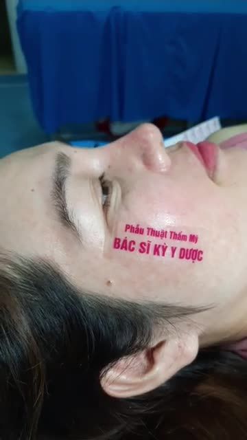 NÂNG MŨI THAY ĐỔI PHONG THỦY