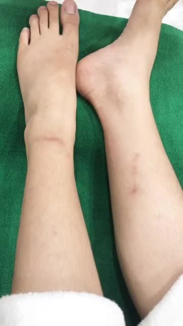 BVTM Đông Á tin rằng có rất nhiều bạn nữ gặp phải tình trạng sẹo thâm như thế này, không chỉ ở chân, sẹo thâm còn có thể xuất hiện nhiều ở lưng, cánh tay, ở mặt..