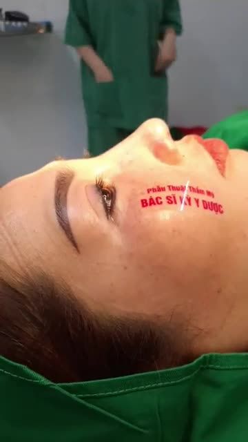 NÂNG MŨI CẤU TRÚC SỤN TAI ĐA LỚP