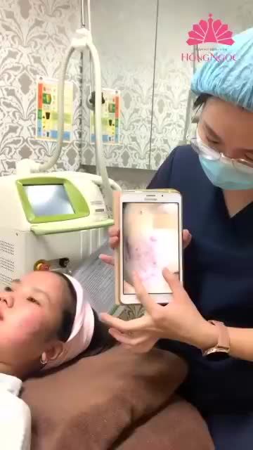 BẤT NGỜ VỚI KẾT QUẢ SAU 3 BUỔI ĐIỀU TRỊ MỤN VIÊM