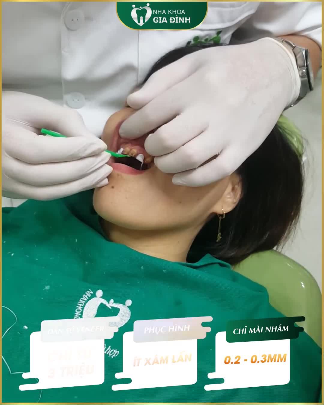 DÁN SỨ VENER PHỤC HÌNH THẨM MỸ RĂNG ĐỈNH CAO