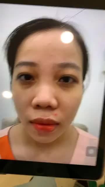 Đừng mãi tự ti vì khuyết điểm mũi Khách hàng với nền mũi cũ tương đối phức tạp, nhiều khuyết điểm đi kèm