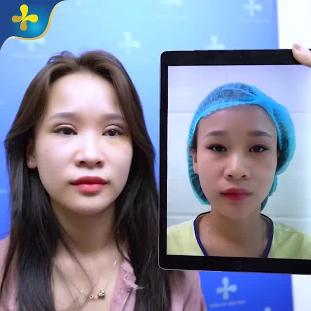 Kết quả cắt mí Golden Eyes chinh phục em gái Hà Nội.