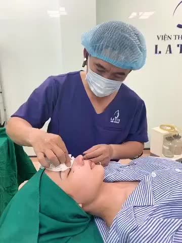 Mũi cấu trúc sửa lại, surgiform, thu cánh mũi Thực hiện bởi Ekip Bs. Trịnh Quang Đại - Viện thẩm mỹ Latin