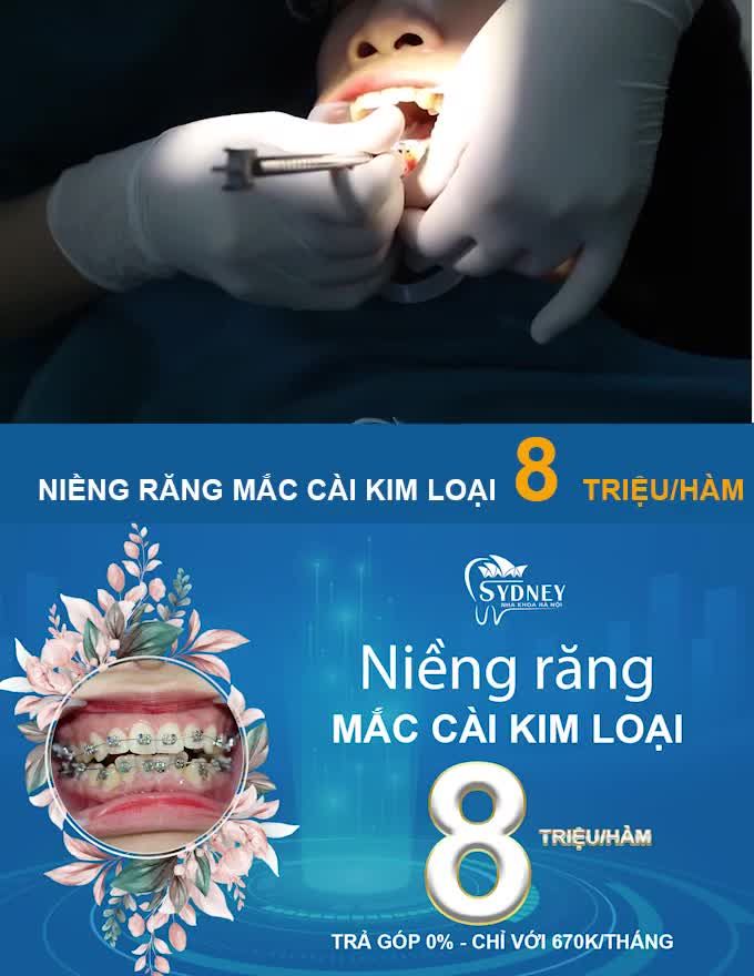 NIỀNG RĂNG CHO TRẺ EM CÓ TỐT KHÔNG