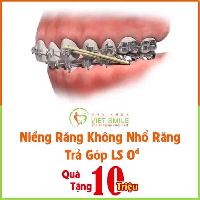Niềng răng không nhổ răng – Trả góp lãi suất 0đ