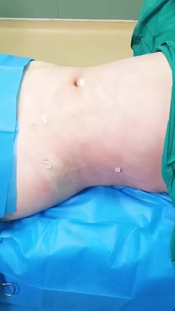 TRIỆT TIÊU SẠCH MỠ BỤNG 2 NGẤN, ĐEM LẠI VÒNG EO “CON KIẾN” TỨC THÌ