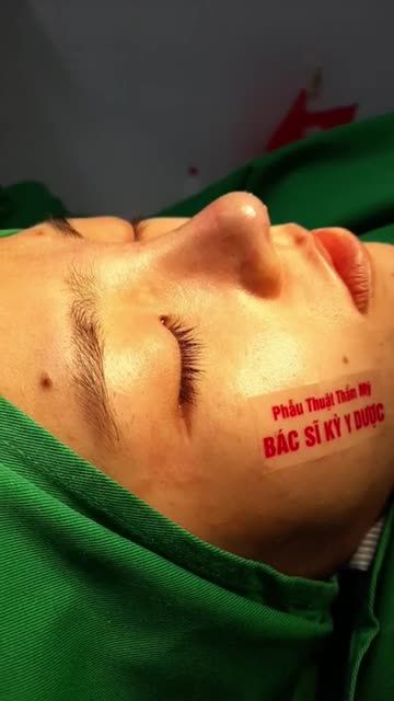 NÂNG MŨI CẤU TRÚC ĐA LỚP DÁNG MŨI HOÀN HẢO SAU 60 PHÚT