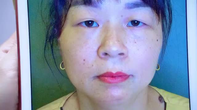 Mí khó ở mức độ như thế nào đội ngũ Bác sĩ tại Dr.Hải Lê đều giải quyết được tất cả mọi khuyết điểm cho khách hàng
