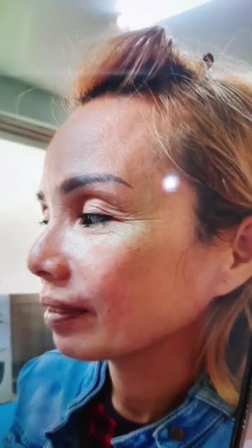 Tái khám cắt chỉ sau 7 ngày TREO CUNG MÀY VỚI ĐƯỜNG KHÂU THẨM MỸ SIÊU MẢNH