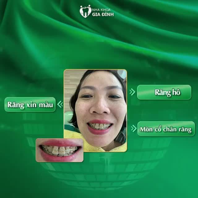 THẨM MỸ RĂNG ĐÃ THAY ĐỔI NỤ CƯỜI CỦA CHỊ HỒNG HÀ NHƯ THẾ NÀO?