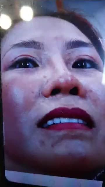 GIẢI CỨU MŨI HỎNG, MŨI MỎNG DA SAU 4 THÁNG NÂNG MŨI BẰNG SỤN NHÂN TẠO Ở CƠ SỞ KHÁC