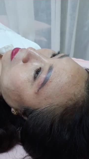 Tái khám cắt chỉ sau 7 ngày TREO CUNG MÀY VỚI ĐƯỜNG KHÂU THẨM MỸ SIÊU MẢNH