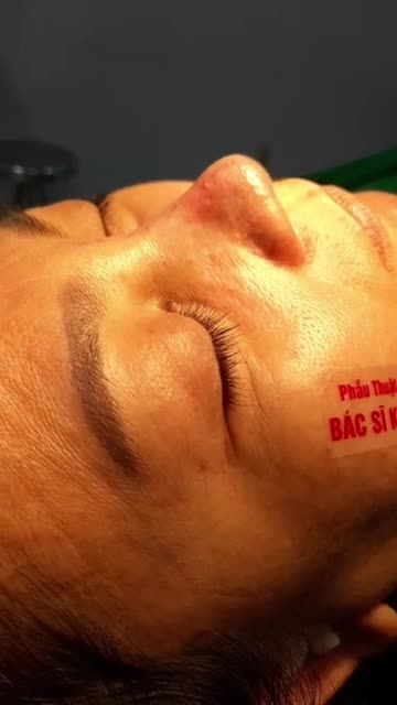 NÂNG MŨI CẤU TRÚC ĐA LỚP DÁNG MŨI HOÀN HẢO SAU 60 PHÚT