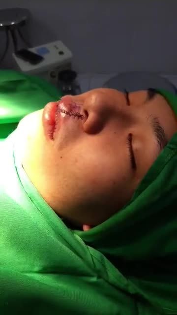 KHẮC PHỤC TÌNH TRẠNG KHUYẾT LÕM MÔI DO DỊ TẬT SỨT MÔI BẨM SINH