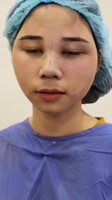 Kết quả sau 60p Cấy mỡ mặt Bio Gen của chị KH dễ thương nhà Đông Á Sài Gòn: 218 Nguyễn Trãi, P3,Q.5