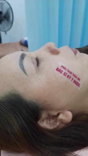 Tái khám cắt chỉ CẮT MẮT MÍ TRÊN VÀ DƯỚI VỚI ĐƯỜNG KHÂU THẨM MỸ SIÊU MẢNH