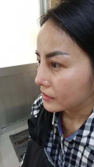 Tái khám sau 20 ngày NÂNG MŨI SỤN TAI HAI LỚP