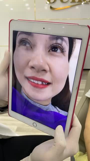Chị KH xinh đẹp đã làm thẩm mỹ 16 răng sứ được 1 năm rồi ạ