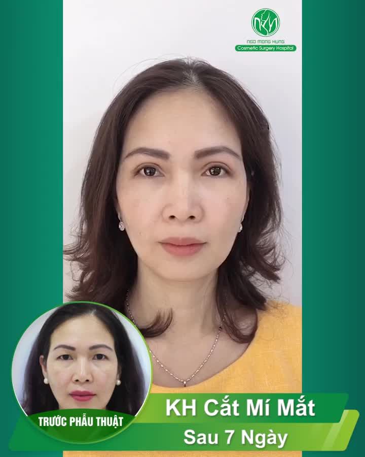 CHỊ KHÁCH QUAY LẠI CẮT CHỈ SAU 7 NGÀY CẮT MÍ