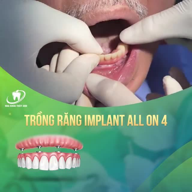 MẤT RĂNG TOÀN HÀM KHÔI PHỤC NHƯ THẾ NÀO