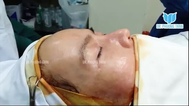 NÂNG MŨI SỤN SƯỜN TOÀN PHẦN KHẮC PHỤC MŨI DI LỆCH, LỘ SỐNG, CỤP ĐẦU MŨI, KHUYẾT CÁNH MŨI