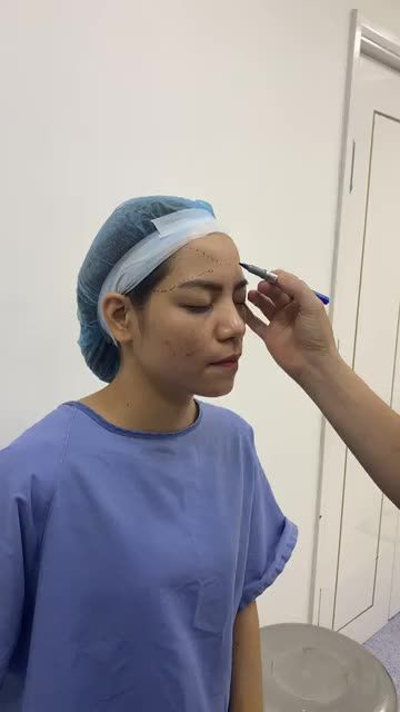 Quá trình đo vẽ cấy mỡ toàn mặt Biogen tại BVTM Đông Á