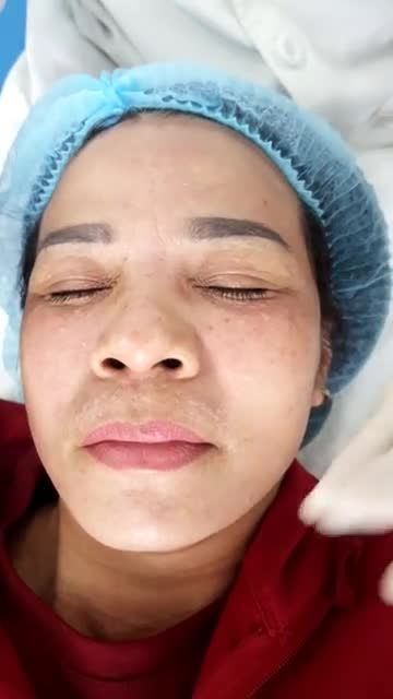 Mụn thịt chi chít phần mắt khiến gương mặt sần sùi, xấu xí