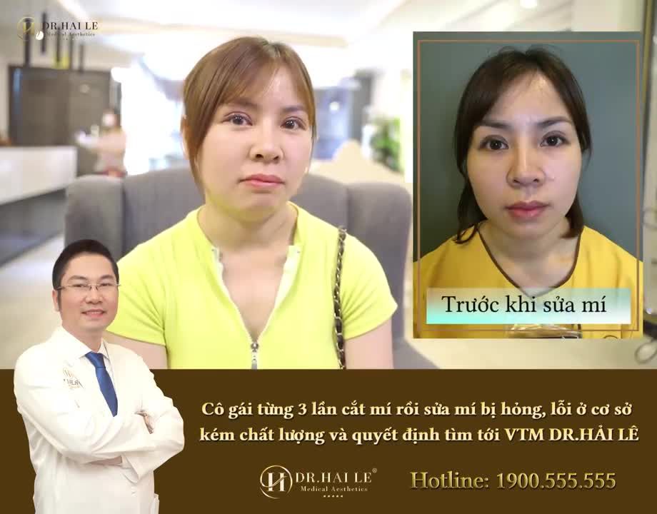 TÂM SỰ CỦA CÔ GÁI VỀ HÀNH TRÌNH TÌM LẠI ĐÔI MẮT ĐẸP SAU 3 LẦN CẮT MÍ HỎNG.!!