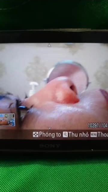 DÁNG MŨI SAU 45 PHÚT TẠI NHÀ BS KỲ Y DƯỢC