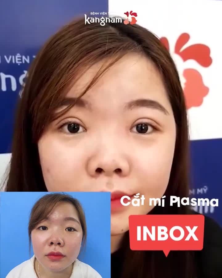 MẮT MỘT MÍ, HAI MẮT XA NHAU COMBO HOÀN HẢO: CẮT MÍ + TẠO KHÓE MẮT TRONG