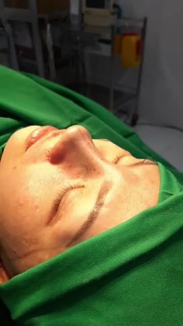 CA NÂNG MŨI SỬA LẠI CHỈ SAU 45 PHÚT TẠI NHÀ  BS KỲ Y DƯỢC