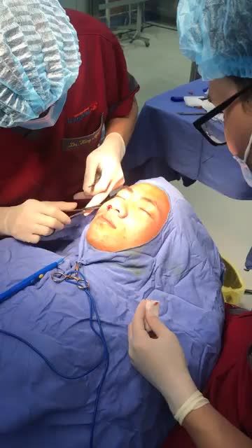 Quá trình thu nhỏ cánh mũi