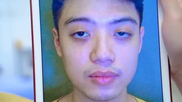 Nhược cơ nâng mi toàn phần bẩm sinh + đã cắt mí tại 1 cơ sở khác nhưng không thành công khiến cả 2 mắt sụp mí nặng có khắc phục được không?