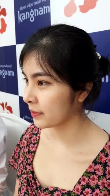 Nụ cười hạnh phúc của khách hàng với dáng mũi cấu trúc tự nhiên