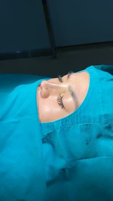 DÁNG MŨI CỰC PHẨM EKIP SLINE VỪA THỰC HIỆN XONG