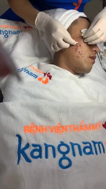 Quy trình điều trị mụn De Acne tại Kangnam