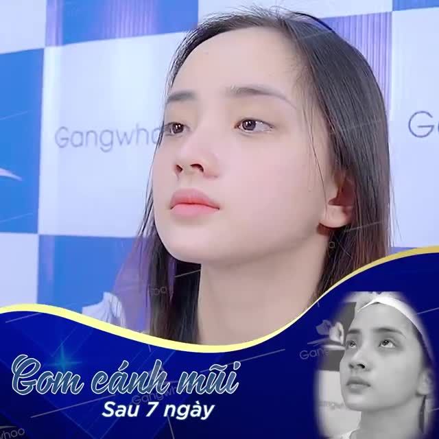 DIỆN MẠO HÀI HÒA VỚI CẮT CÁNH MŨI KHÔNG SẸO