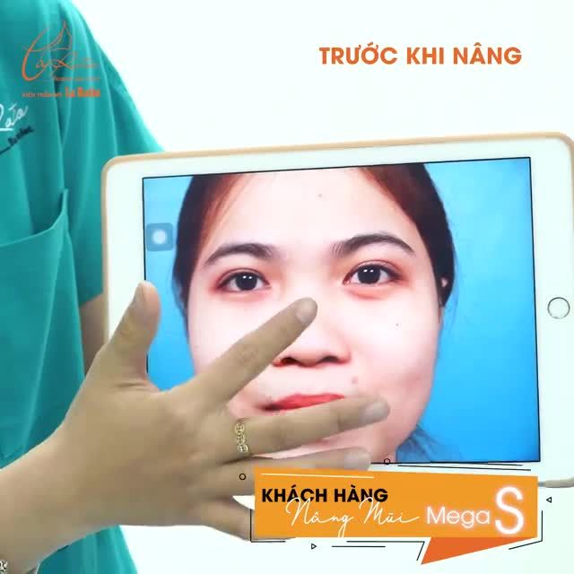 NÂNG MŨI MEGA S - CÔNG NGHỆ ĐỘC QUYỀN TẠI VIỆN THẢM MỸ LA RATIO