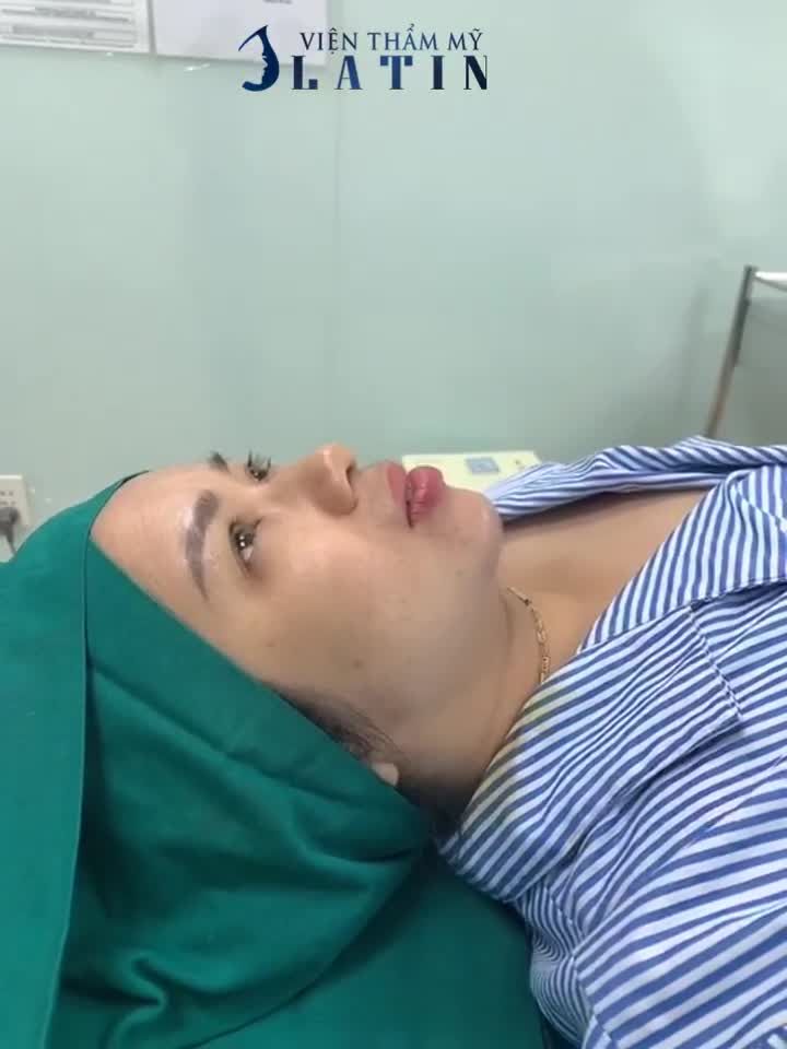 XÓA BỎ CẰM LẸM, NGẮN, VUÔNG VỚI ĐỘN CẰM US PROSIL