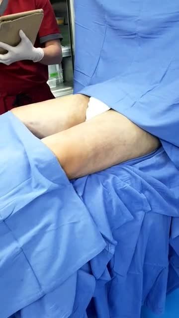 Đùi cột đình, nặng nề khi di chuyển và màn Giảm mỡ đầy bất ngờ